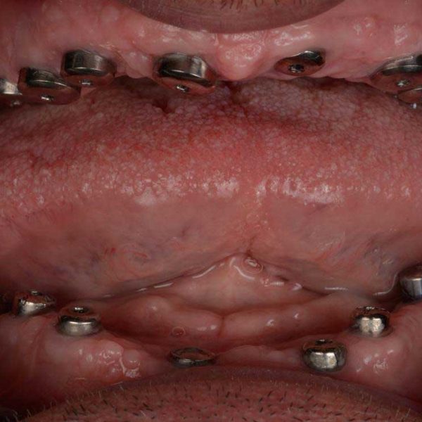 Diagnosis stage of case treatment full mouth reconstruction with 15 implants and bilateral sinus lift referring from Baghbahadoran 1 1 1