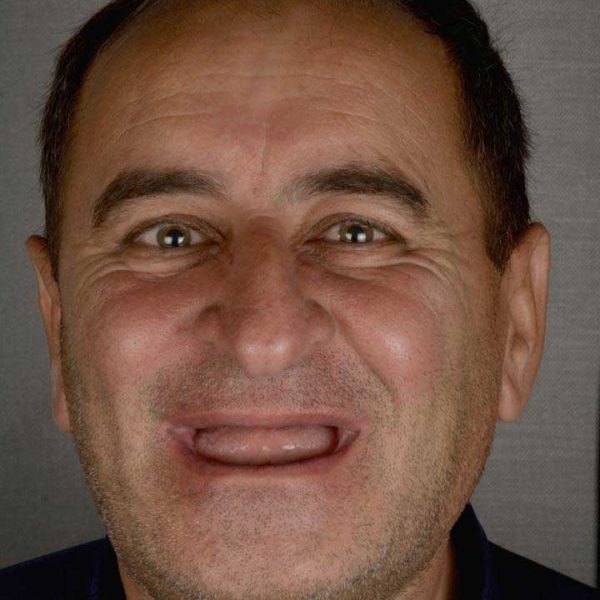 مرحله تشخیص کیس درمانی، بازسازی کامل دهان با ۱۵ واحد ایمپلنت و سینوس لیفت دوطرفه مراجعه کننده از باغبهادران