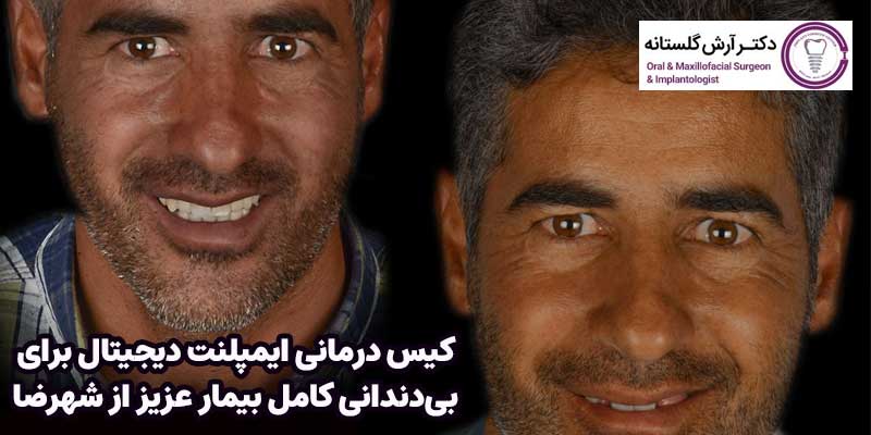 کیس درمانی ایمپلنت دیجیتال برای بیدندانی کامل برای بیمار عزیز از شهرضا