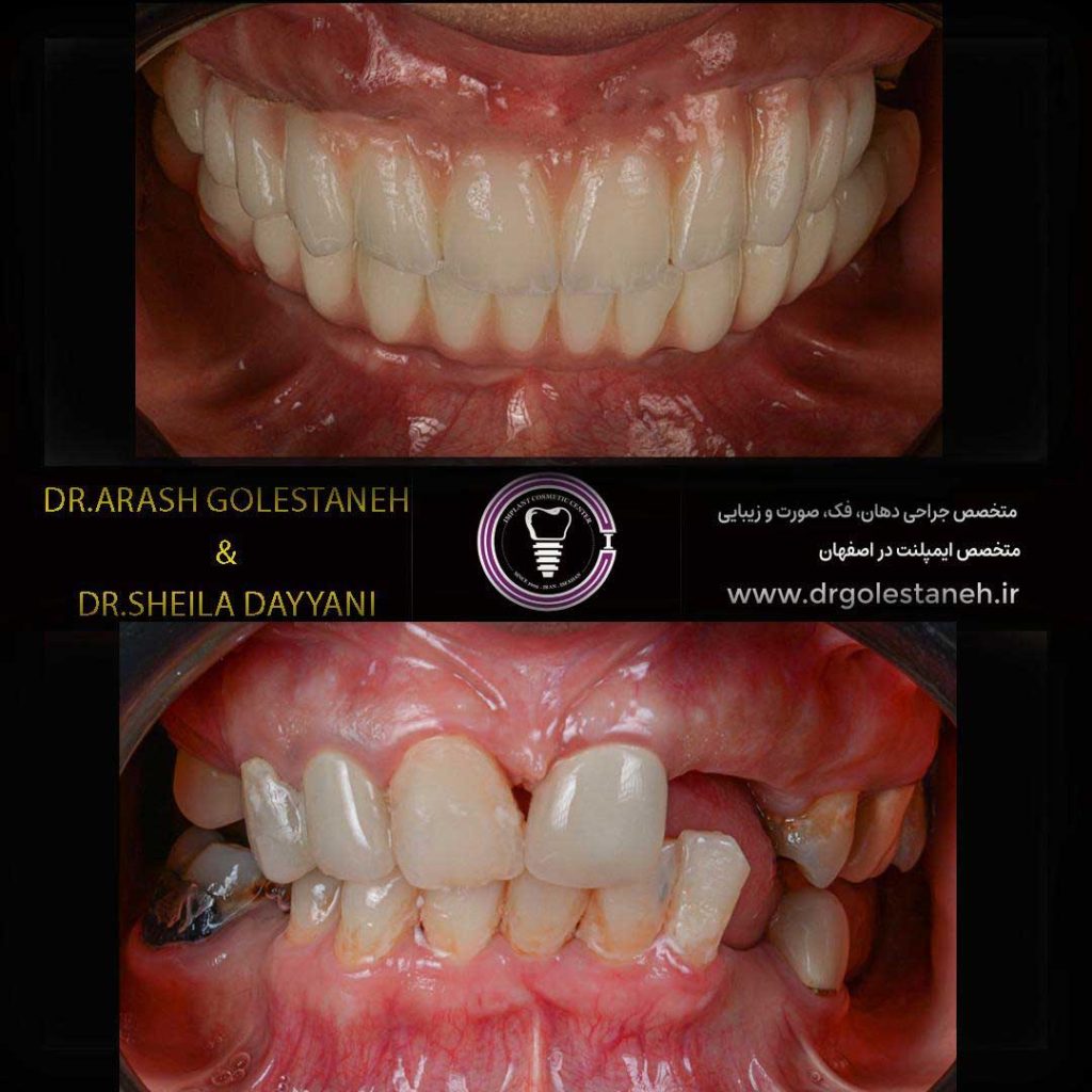 بازسازی کامل دهان (Full Mouth Rehabilitation) با ایمپلنتهای دیجیتال و رویکرد ترکیبی حفظ دندان توسط دکتر آرش گلستانه