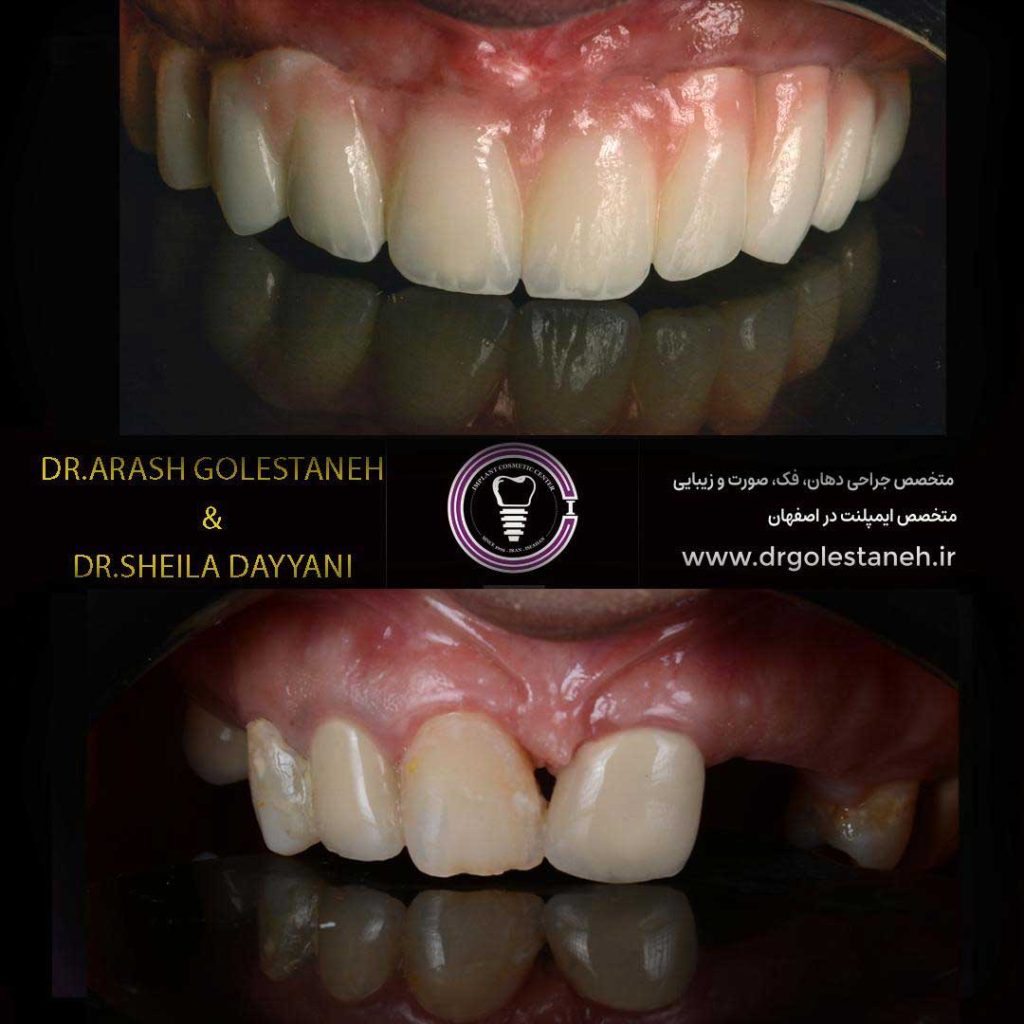 بازسازی کامل دهان (Full Mouth Rehabilitation) با ایمپلنتهای دیجیتال و رویکرد ترکیبی حفظ دندان توسط دکتر آرش گلستانه