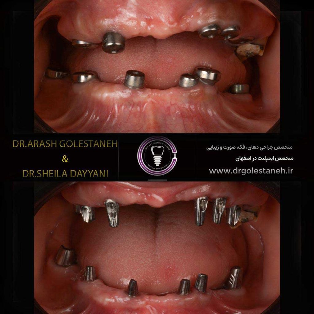 Full Mouth Rehabilitation with Digital Implants and a Combined Tooth Preservation Approach by Dr. Arash Golestaneh 6 9