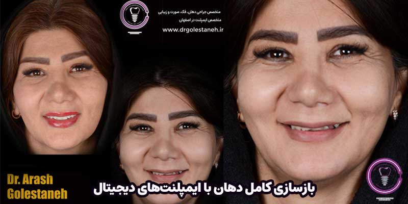 بازسازی کامل دهان (Full Mouth Rehabilitation) با ایمپلنتهای دیجیتال و رویکرد ترکیبی حفظ دندان
