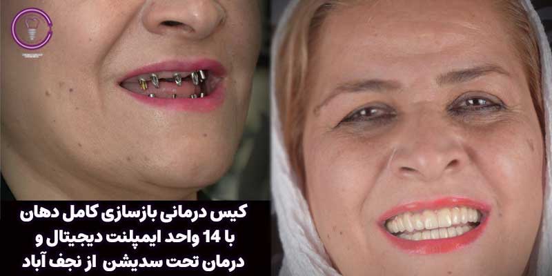 Oral reconstruction with 14 digital implants and treatment under sedation from Najafabad 1