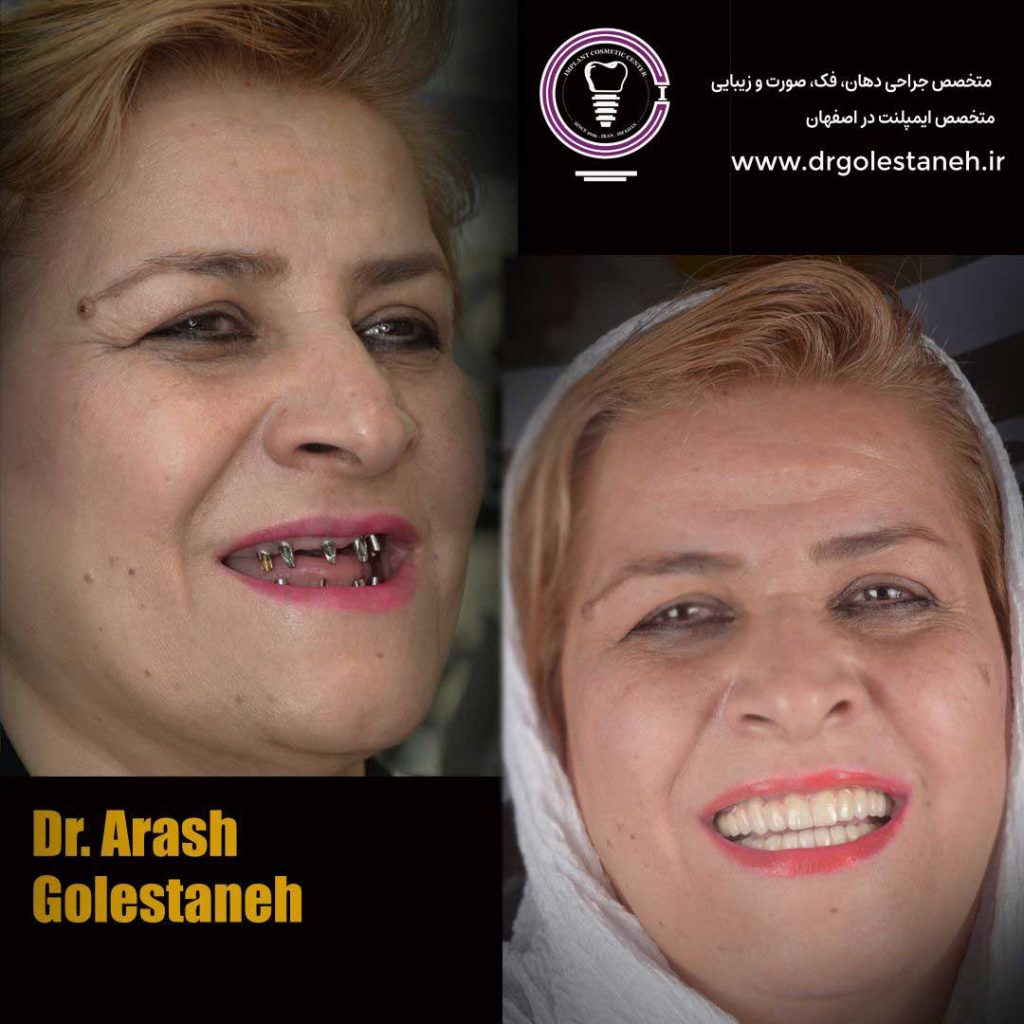 Result of oral reconstruction treatment with 14 digital implants and treatment under sedation from Najafabad 1 10