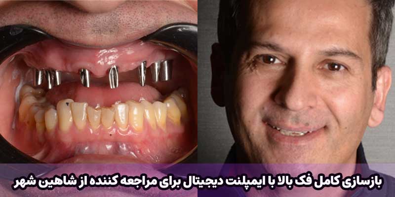 بازسازی کامل فک بالا با ایمپلنت دیجیتال برای مراجعه کننده از شاهین شهر