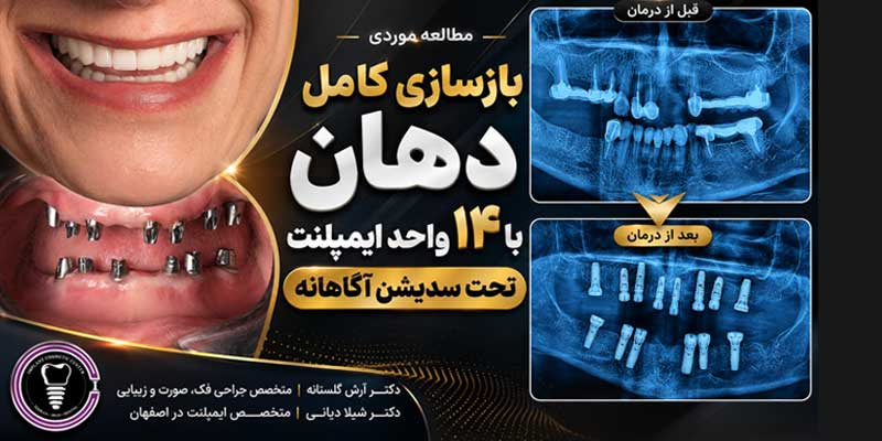 بازسازی کامل دهان با ۱۴ واحد ایمپلنت تحت سدیشن آگاهانه