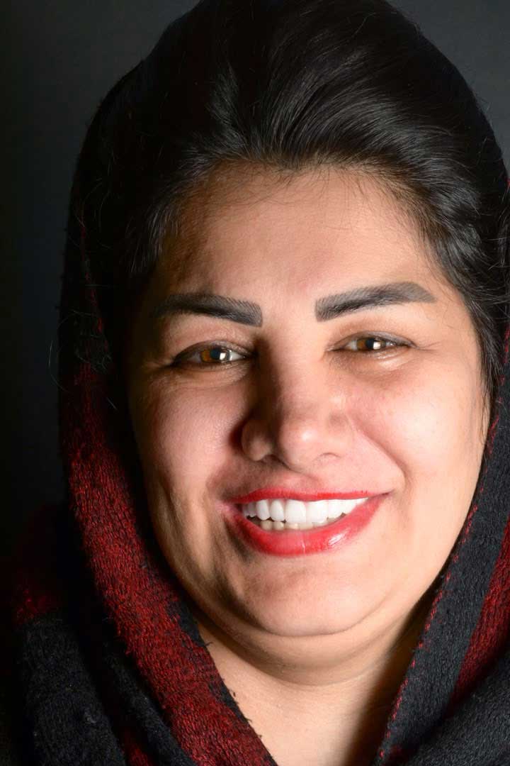 کاشت ۸ واحد ایمپلنت در فک بالا همراه با سینوس لیفت بسته