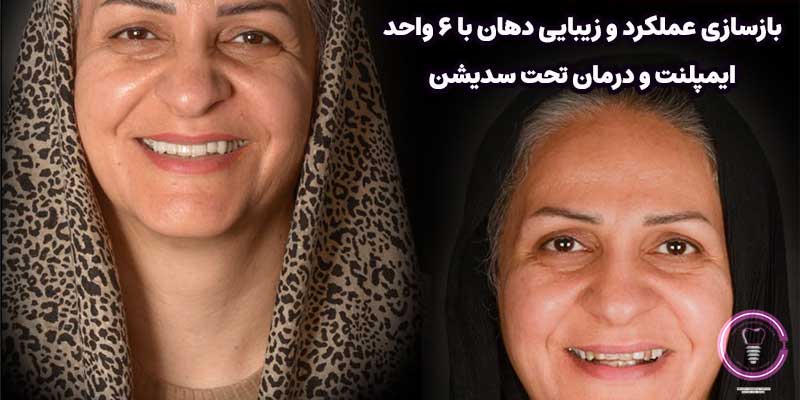 بازسازی عملکرد و زیبایی دهان با ۶ واحد ایمپلنت و درمان تحت سدیشن