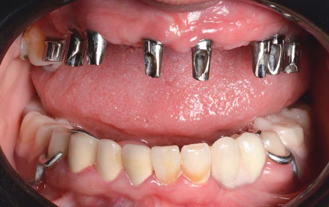 تشخیص و ارزیابی تخصصی کیس کاشت ۸ واحد ایمپلنت در فک بالا همراه با سینوس لیفت بسته