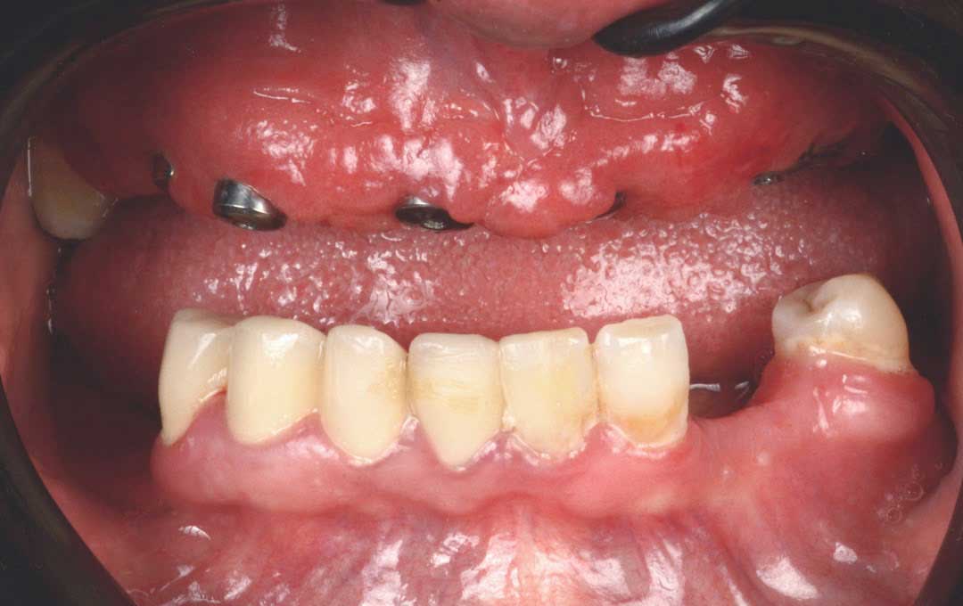 Specialized diagnosis and evaluation of a case of 8 implant units in the upper jaw along with a closed sinus lift 2 1 2