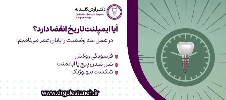 آیا ایمپلنت تاریخ انقضا دارد؟