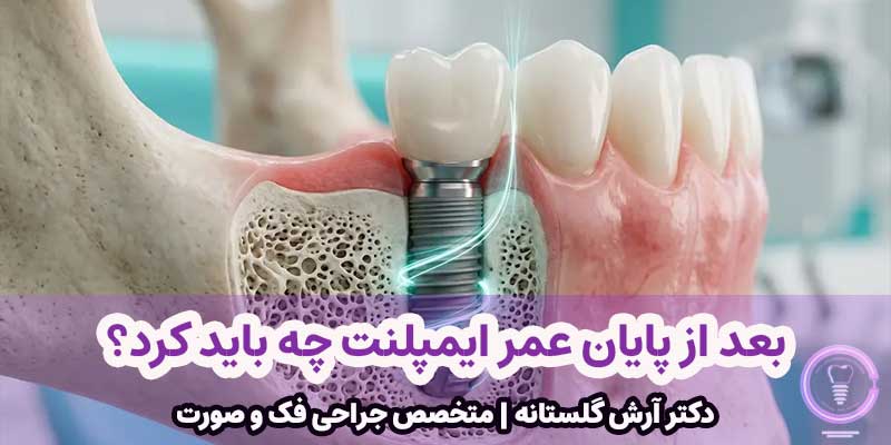 بعد از پایان عمر ایمپلنت چه باید کرد؟