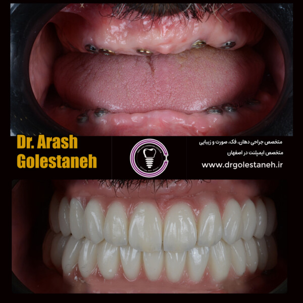 ایمپلنت دیجیتال در اصفهان دکتر ارش گلستانه