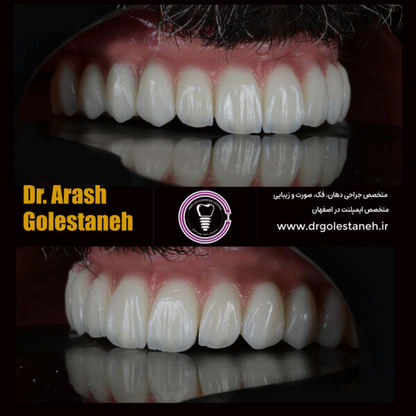 ایمپلنت دیجیتال در اصفهان دکتر ارش گلستانه