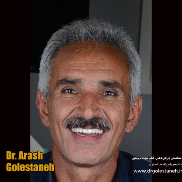 ایمپلنت دیجیتال در اصفهان دکتر ارش گلستانه