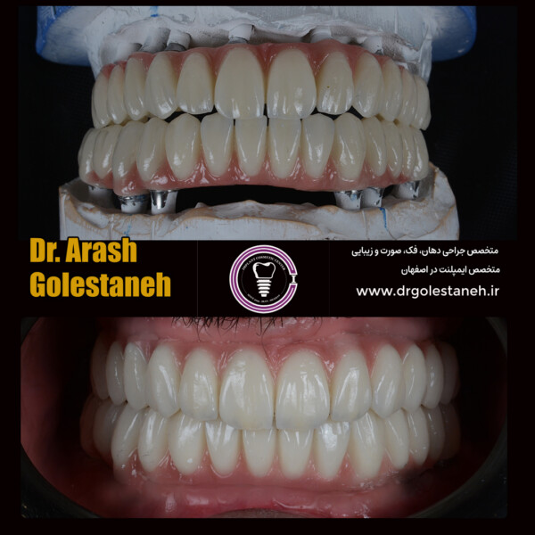 ایمپلنت دیجیتال در اصفهان دکتر ارش گلستانه